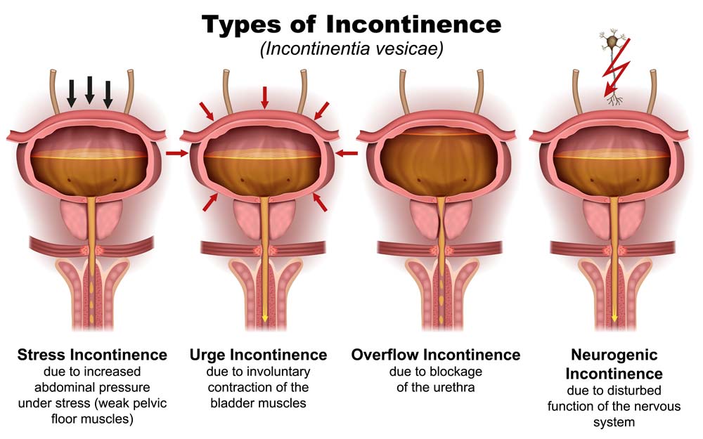 Incontinence Issues with PSP