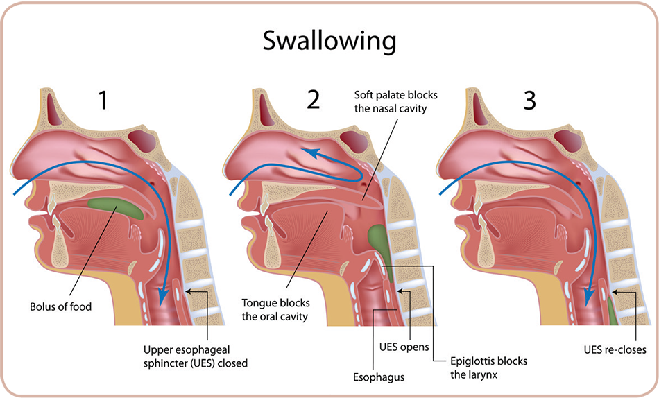 Swallowing issues and symptoms associated with PSP